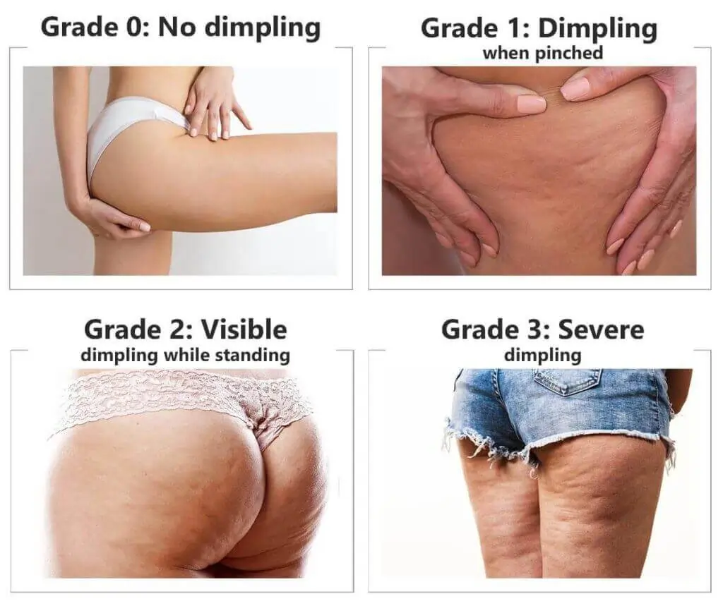 Representation of the stages of cellulite development Luton